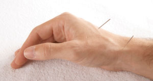 Hand having Acupuncture